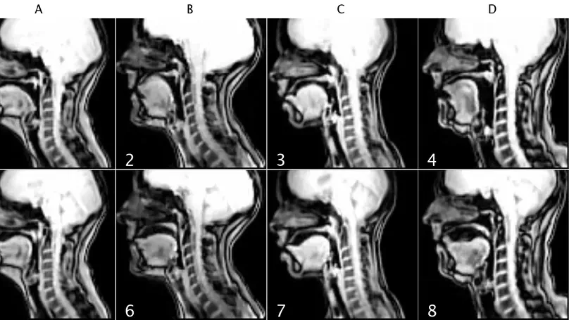 Phonetic accuracy in French learners of English: towards a bilingual database combining articulatory MRI and audio